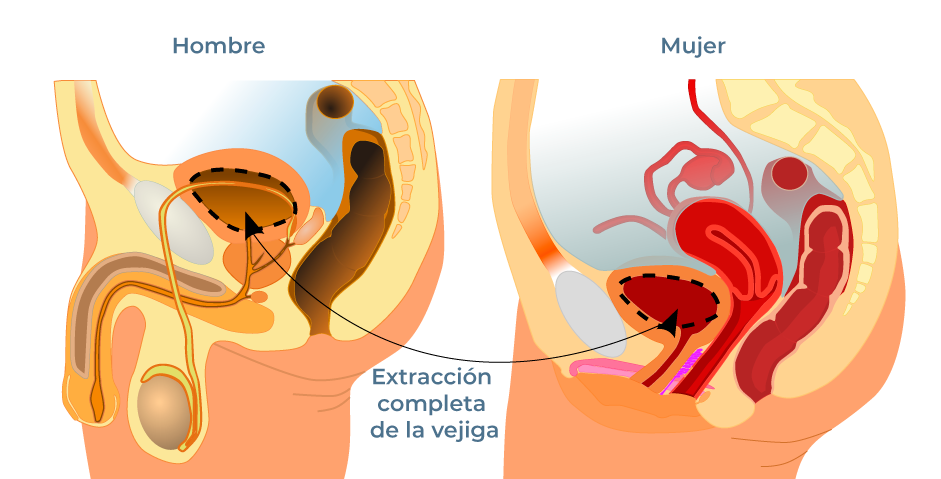 Extraccion completa de la vejiga Medellín