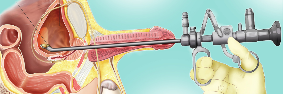 Resección Transuretral de Tumor Vesical Medellín